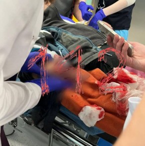 В Красногорске 10-летний мальчик нашёл на земле свернутую десятирублёвку, при попытке взять её произошёл взрыв