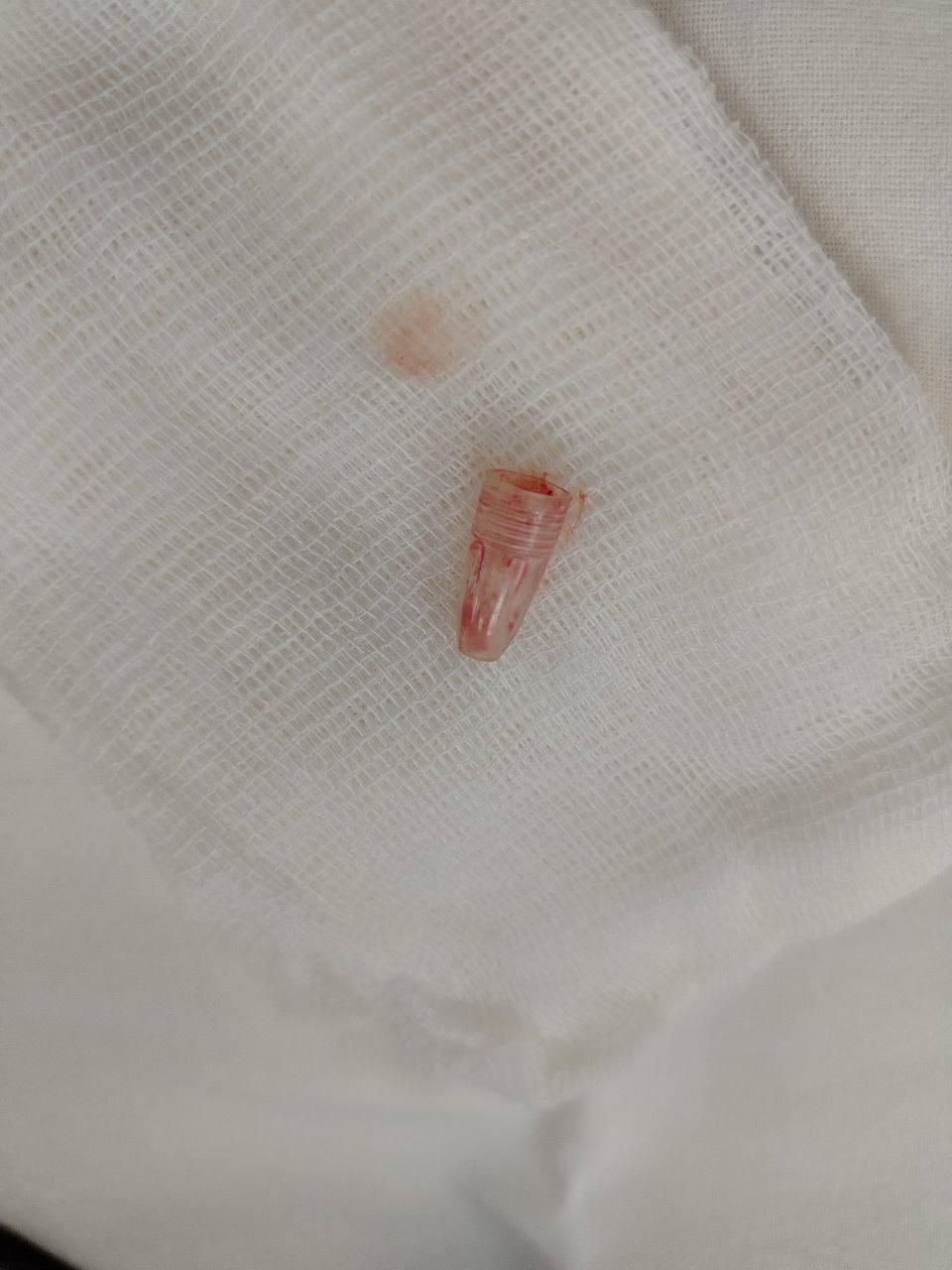 Калужские хирурги достали колпачок от ручки из бронхов школьницы