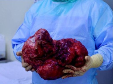 В Калужской области врачи вырезали мужчине огромную опухоль