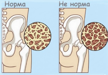 Как сохранить крепость костей после 55: секреты здоровья