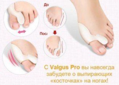 Как избавиться от косточек на ногах в домашних условиях