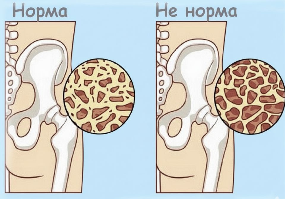 Как сохранить крепость костей после 55: секреты здоровья